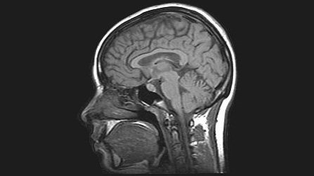 Satellite Software Adapted for Alzheimer's Brain Scans